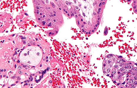 فحص الزغابات المشيمية Chorionic villus sampling
