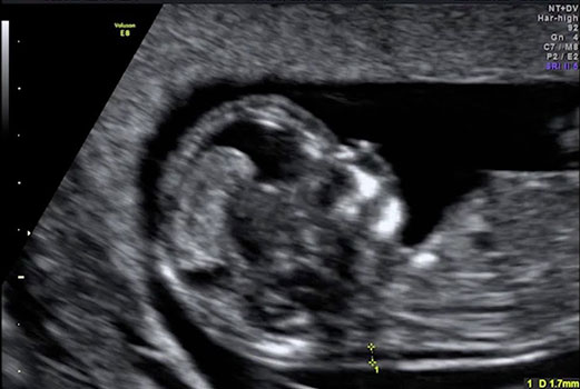 قياس الشفافية القفوي Nuchal scan