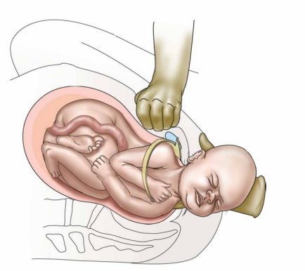 عسر ولادة الكتف Shoulder dystocia