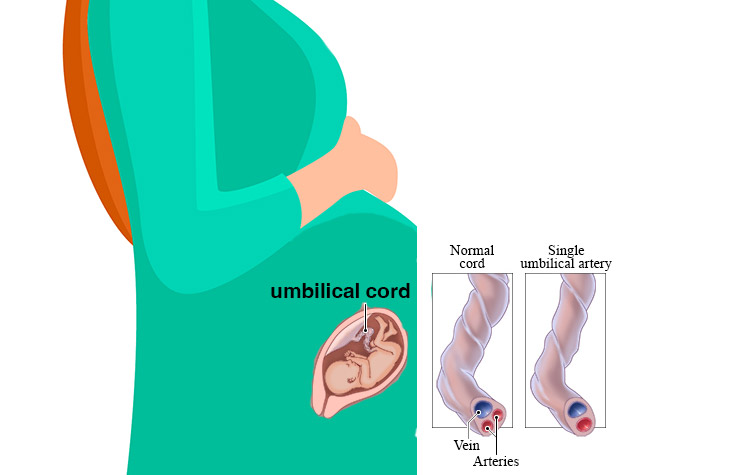 الحبل السري ذو الوعائين الدمويين Two-Vessel Cord