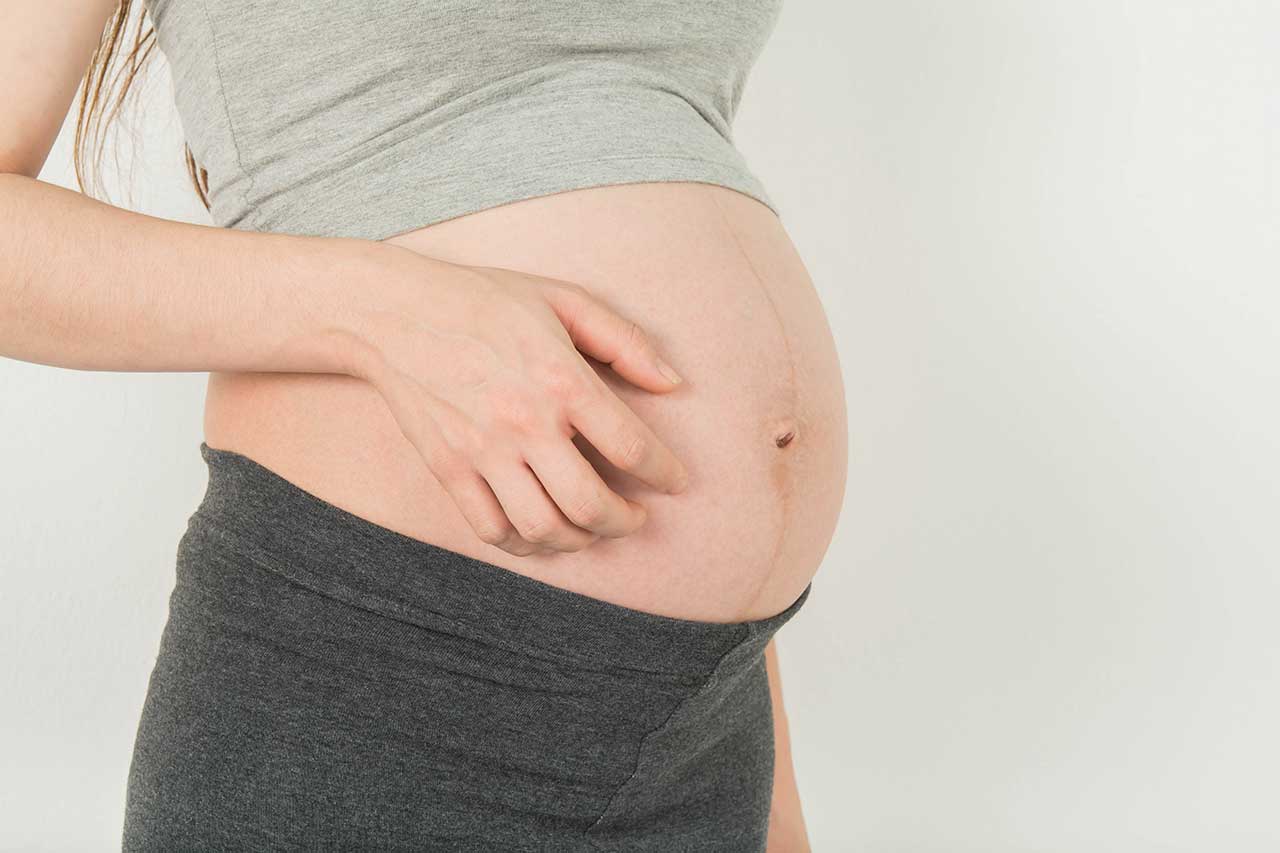 الركود الصفراوي في الحمل cholestasis