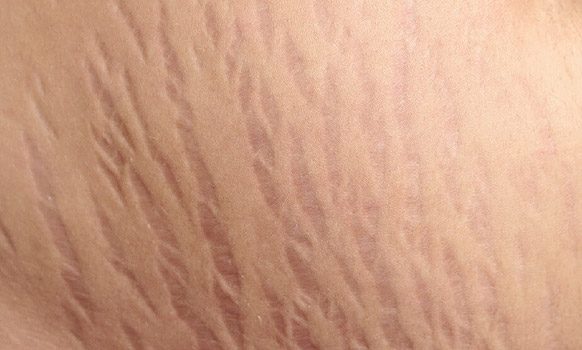 علامات تمدد جلد الحامل stretch marks