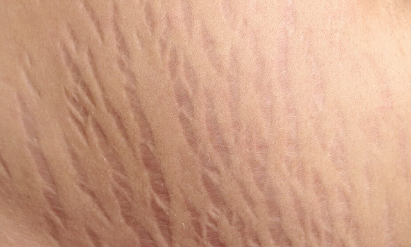 علامات تمدد جلد الحامل stretch marks