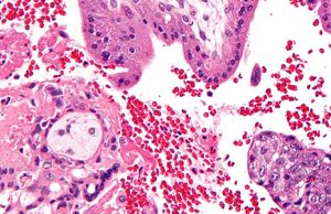فحص الزغابات المشيمية Chorionic villus sampling