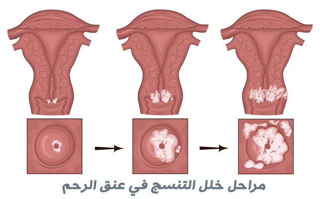 خلل التنسج في عنق الرحم | حثل عنق الرحم Cervical dysplasia