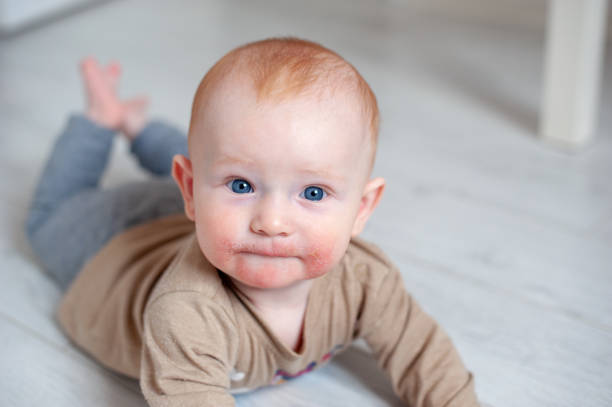 الإكزيما للطفل في الشهر الخامس | طفح جلدي