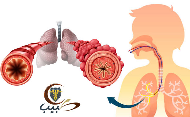 الربو لدى الأطفال