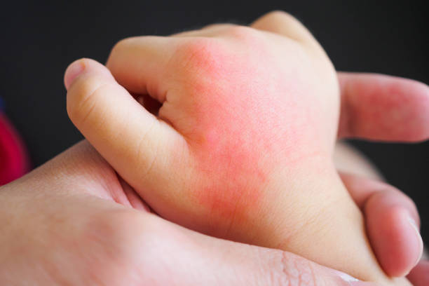 الإكزيما وأشكال الطفح الجلدي لدى الأطفال