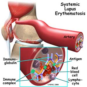 الذئبة الحمراء الجهازية / الذئبة الحمامية  System Lupus Erythematosus (SLE)