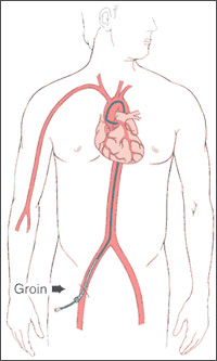 Cath-via-groin.jpg