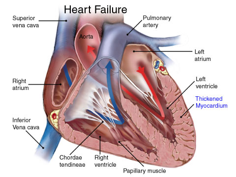 HeartFailure.jpg