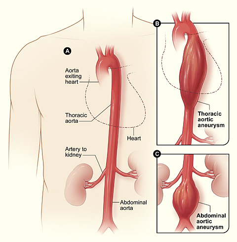 aneurysm_aortic.jpg