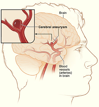 aneurysm_cerebral.jpg