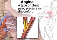 angina.jpg