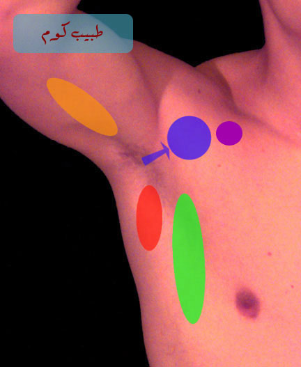 axillary_lymph_label%20copy.jpg