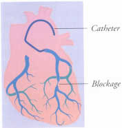 coronary_angiogram.jpg