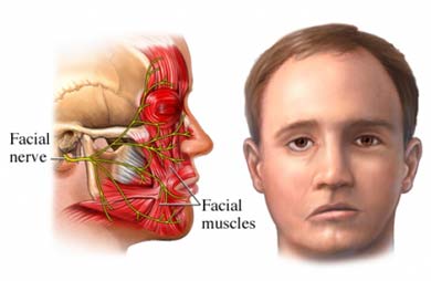 شلل بل، شلل بيل، شلل العصب السابع، أبو الوجوه، الشلل الوجهي Bell's palsy, Bell Palsy, facial palsy