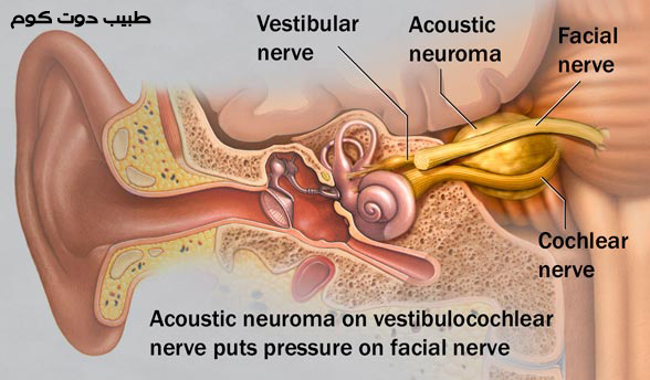 الورم العصبي السمعي Acoustic neuroma