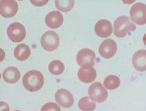 انيميا الامراض المزمنة Anemia of chronic disease