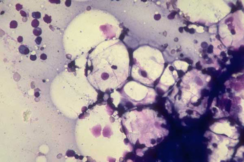 الانيميا الابلاستية Aplastic Anemia