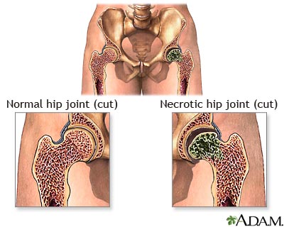 Aseptic necrosis الموت الخلوي اللاميكروبي، نخر عقيم