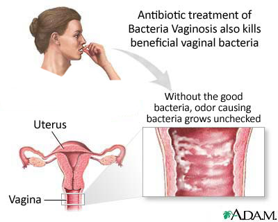الداء المهبلي البكتيري في فترة الحمل Bacterial Vaginosis