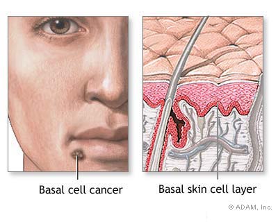 Basal Cell Carcinoma سرطان الخلية القاعدية