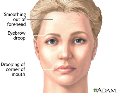 Bell Palsy