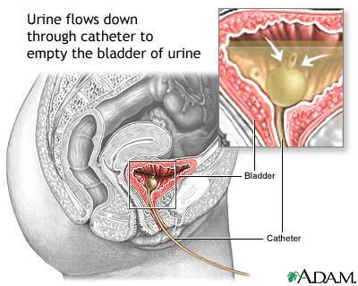 Bladder catheterization female