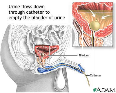 Bladder catheterization male