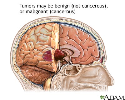 Brain Tumors