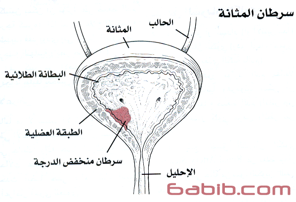 Cancer of the Bladder