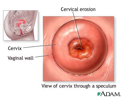 قرحة عنق الرحم Cervical Erosion