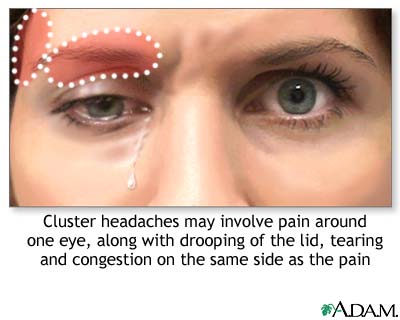الصداع العنقودي Cluster Headaches