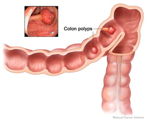 سرطان القولون Colon Cancer