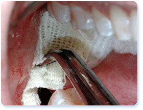 Tooth Removal, Tooth Extractions