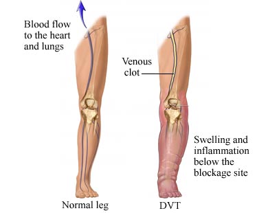 Deep Vein Thrombosis