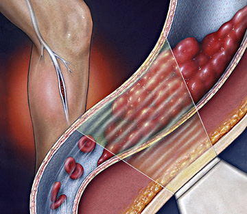 التجلّط الوريدي العميق Deep vein thrombosis