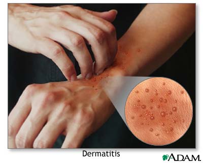 Dermatitis and Eczema