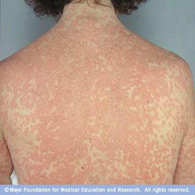 طفح دوائي Drug Rash