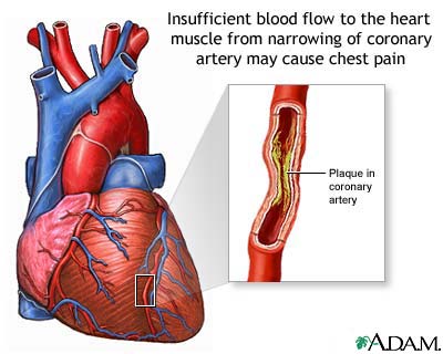 Elevated Cholesterol