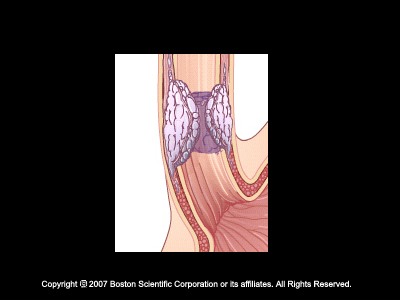 Esophageal Stricture