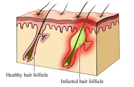 Folliculitis التهاب بصيلة الشعر،التهاب الجريبات
