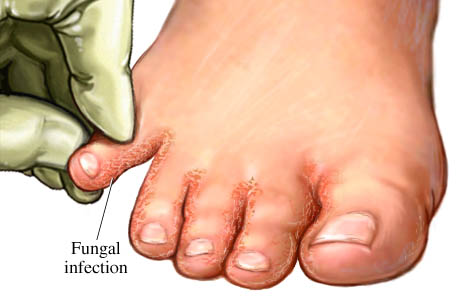 Fungal infection