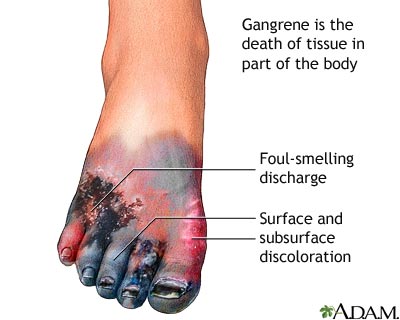 غرغرينة - غنغرينة - موات - موت عضوي Gangrene