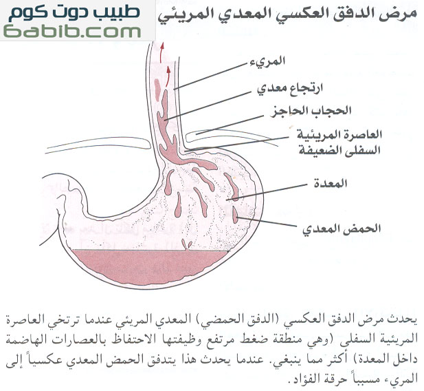 الارتجاع المعدي المريئي Gastroesophageal Reflux Disease