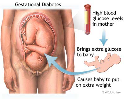 سكر الحمل، السكري الحملي Gestational Diabetes