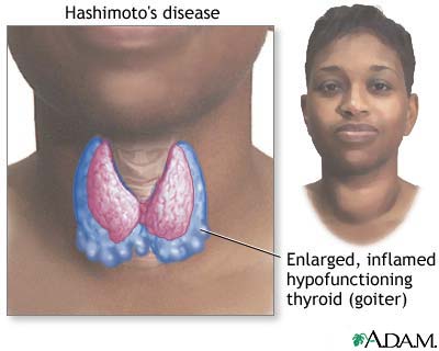 Hashimoto disease Thyroiditis