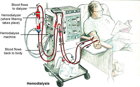 Hemodialysis