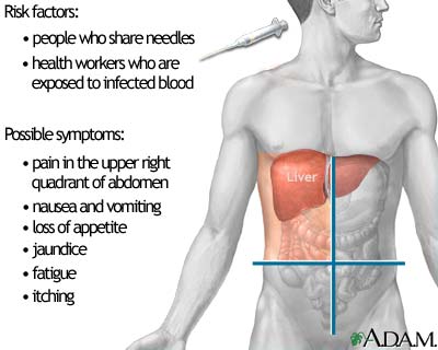 فيروس التهاب الكبد ج Hepatitis C